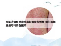 哈尔滨银屑病治疗最好医院在哪里 哈尔滨银屑病专科特色医院