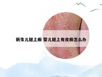 新生儿腿上癣 婴儿腿上有皮癣怎么办