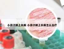 小孩子脚上长癣 小孩子脚上长癣怎么治疗