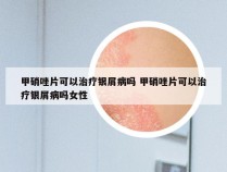 甲硝唑片可以治疗银屑病吗 甲硝唑片可以治疗银屑病吗女性