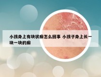 小孩身上有块状癣怎么回事 小孩子身上长一块一块的癣