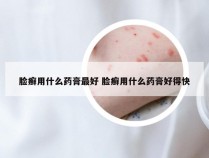 脸癣用什么药膏最好 脸癣用什么药膏好得快