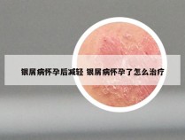 银屑病怀孕后减轻 银屑病怀孕了怎么治疗