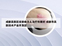 成都高新区皮肤癣怎么治疗效果好 成都市高新技术产业开发区