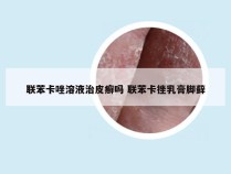 联苯卡唑溶液治皮癣吗 联苯卡挫乳膏脚藓