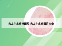 头上牛皮廨痒图片 头上牛皮廨图片大全