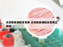 点滴银屑病脱皮发痒 点滴银屑病脱皮发痒正常吗