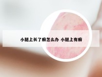 小腿上长了癣怎么办 小腿上有癣