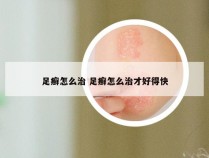 足癣怎么治 足癣怎么治才好得快