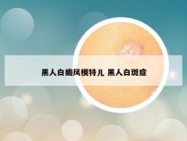 黑人白癜风模特儿 黑人白斑症