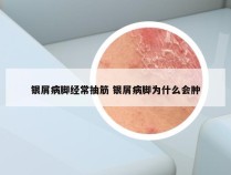 银屑病脚经常抽筋 银屑病脚为什么会肿