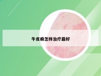 牛皮癣怎样治疗最好