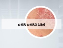 白赖风 白赖风怎么治疗