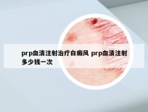 prp血清注射治疗白癜风 prp血清注射多少钱一次