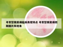 寻常型银屑病临床表现特点 寻常型银屑病初期图片和现象