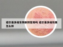 诺尔曼多维生物制剂管用吗 诺尔曼多维效果怎么样