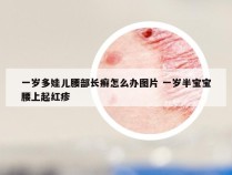 一岁多娃儿腰部长癣怎么办图片 一岁半宝宝腰上起红疹