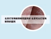 北京打生物制剂哪家医院好 北京可以打生物制剂的医院