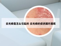 日光癣是怎么引起的 日光癣的症状图片图库