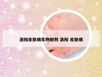 洛阳皮肤病生物制剂 洛阳 皮肤病