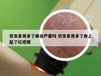 抗生素用多了癣会严重吗 抗生素用多了身上起了红疙瘩