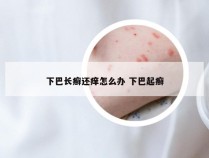 下巴长癣还痒怎么办 下巴起癣