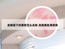 皮癣留下的黑斑怎么去除 皮癣黑色像疤痕