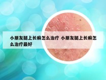 小朋友腿上长癣怎么治疗 小朋友腿上长癣怎么治疗最好