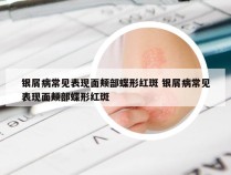 银屑病常见表现面颊部蝶形红斑 银屑病常见表现面颊部蝶形红斑