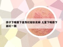 孩子下嘴唇下面发红疑似皮癣 儿童下嘴唇下面红一圈