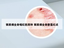 银屑病全身暗红色斑块 银屑病全身都是红点