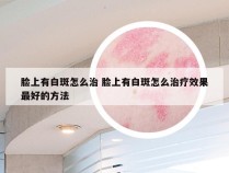 脸上有白斑怎么治 脸上有白斑怎么治疗效果最好的方法