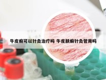 牛皮癣可以针灸治疗吗 牛皮肤癣针灸管用吗