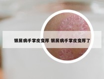 银屑病手掌皮变厚 银屑病手掌皮变厚了