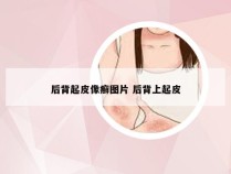 后背起皮像癣图片 后背上起皮