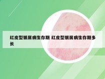 红皮型银屑病生存期 红皮型银屑病生存期多长