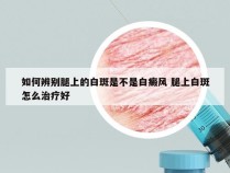 如何辨别腿上的白斑是不是白癜风 腿上白斑怎么治疗好