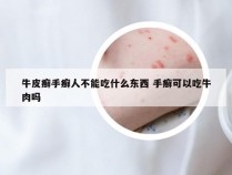 牛皮癣手癣人不能吃什么东西 手癣可以吃牛肉吗