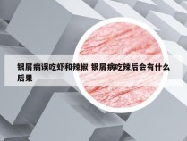 银屑病误吃虾和辣椒 银屑病吃辣后会有什么后果