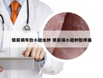 银屑病导致小腿水肿 银屑病小腿肿胀疼痛