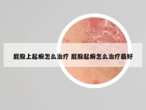 屁股上起癣怎么治疗 屁股起癣怎么治疗最好