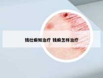 钱壮癣如治疗 钱癣怎样治疗