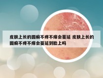 皮肤上长的圆癣不疼不痒会蔓延 皮肤上长的圆癣不疼不痒会蔓延到脸上吗