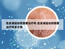 色素减退白斑需要治疗吗 色素减退白斑需要治疗吗多少钱