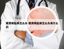 腋窝痒起癣怎么办 腋窝痒起癣怎么办用什么药