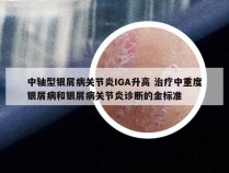 中轴型银屑病关节炎IGA升高 治疗中重度银屑病和银屑病关节炎诊断的金标准