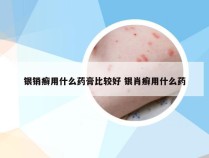 银销癣用什么药膏比较好 银肖癣用什么药