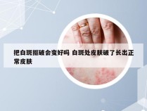 把白斑抠破会变好吗 白斑处皮肤破了长出正常皮肤