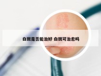 白斑是否能治好 白斑可治愈吗