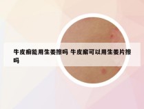 牛皮癣能用生姜擦吗 牛皮廨可以用生姜片擦吗